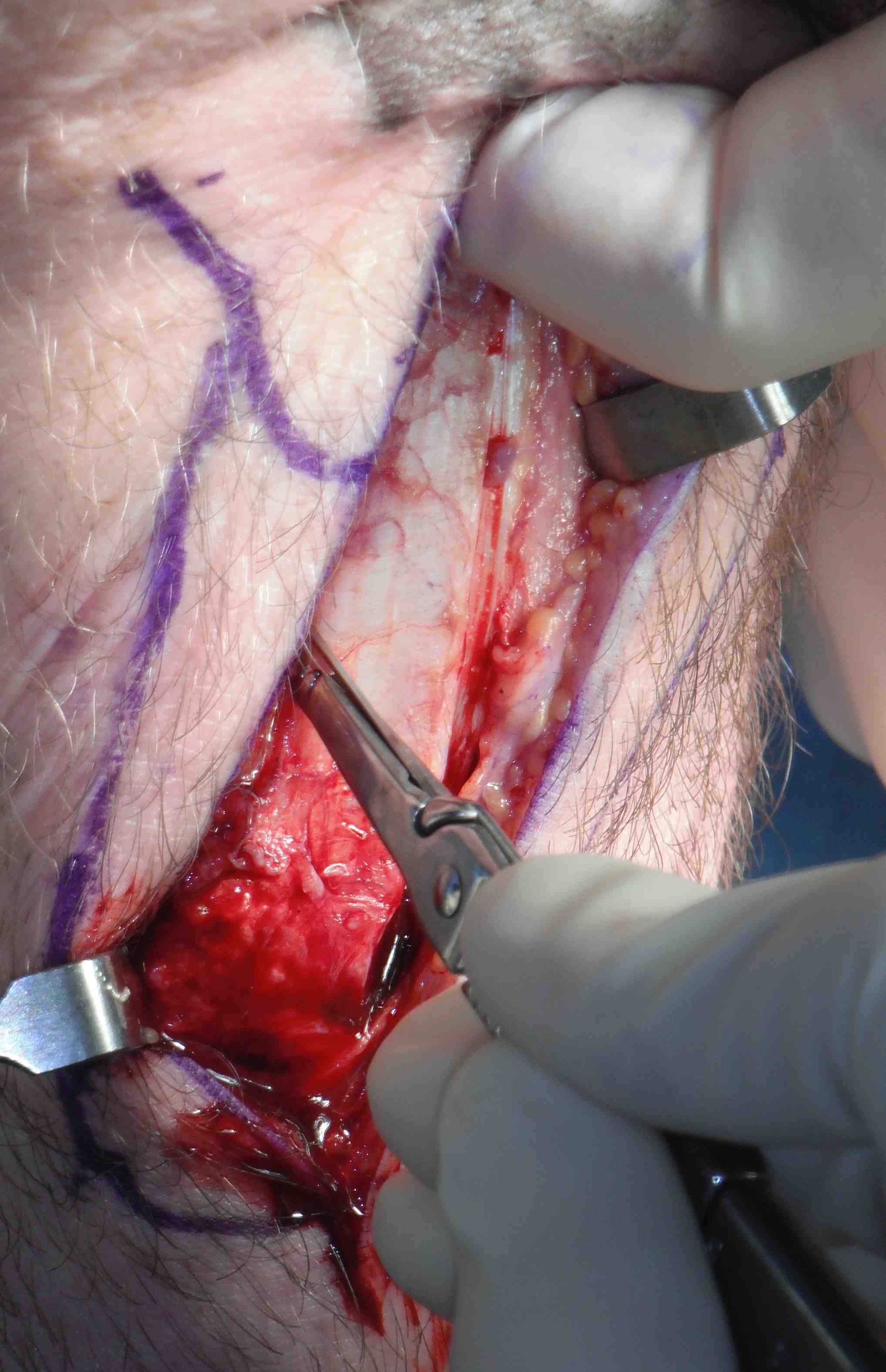 BPTB Lateral Cut